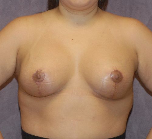 Breast Augmentation And Lift Before & After