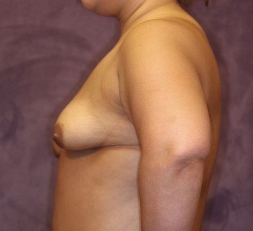 Breast Augmentation And Lift Before & After