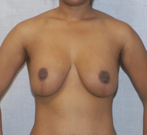Breast Augmentation And Lift Before & After
