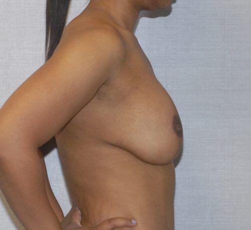 Breast Augmentation And Lift Before & After
