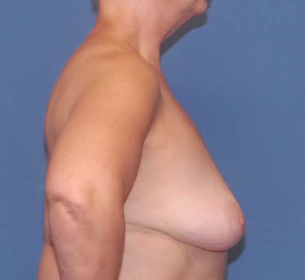 Breast Augmentation And Lift Before & After