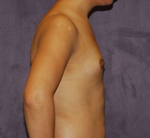 Male To Female Breast Contouring Before & After