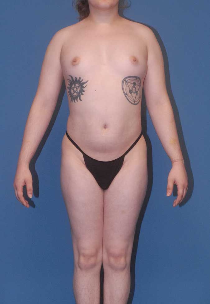 Male To Female Breast Contouring Before & After