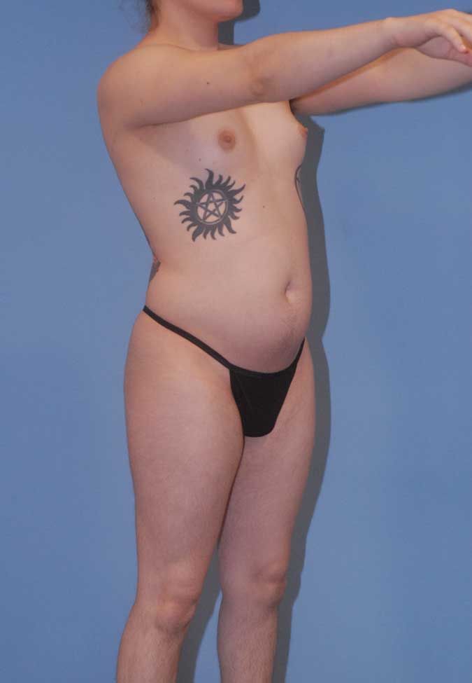 Male To Female Breast Contouring Before & After