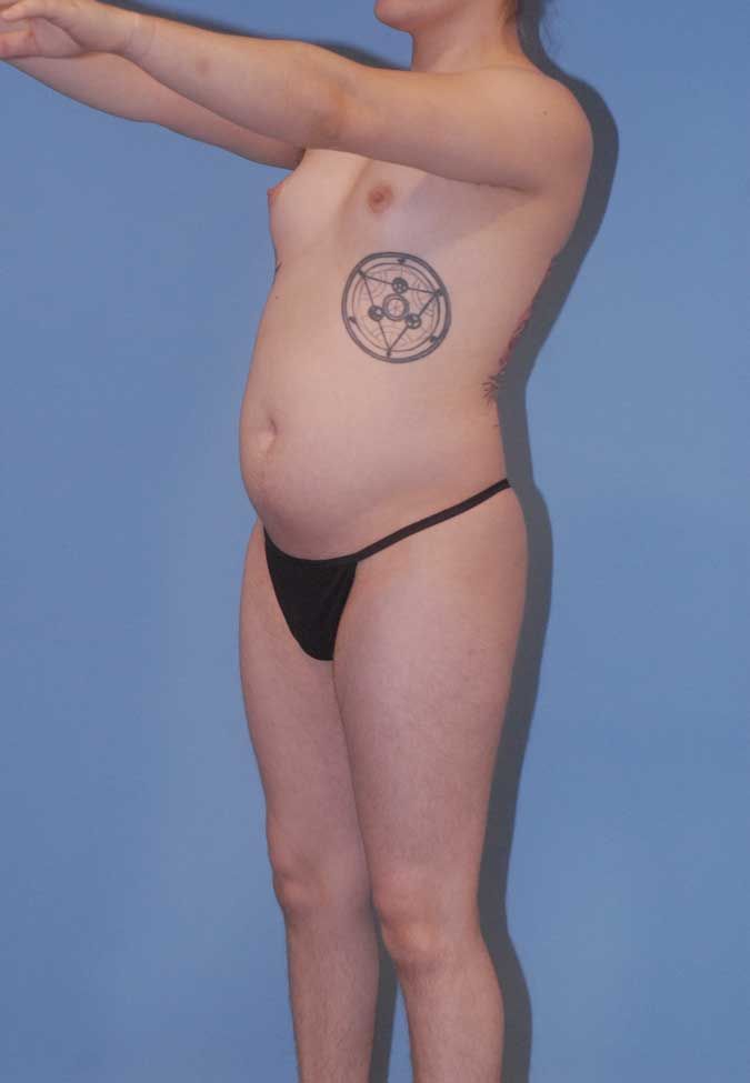 Male To Female Breast Contouring Before & After