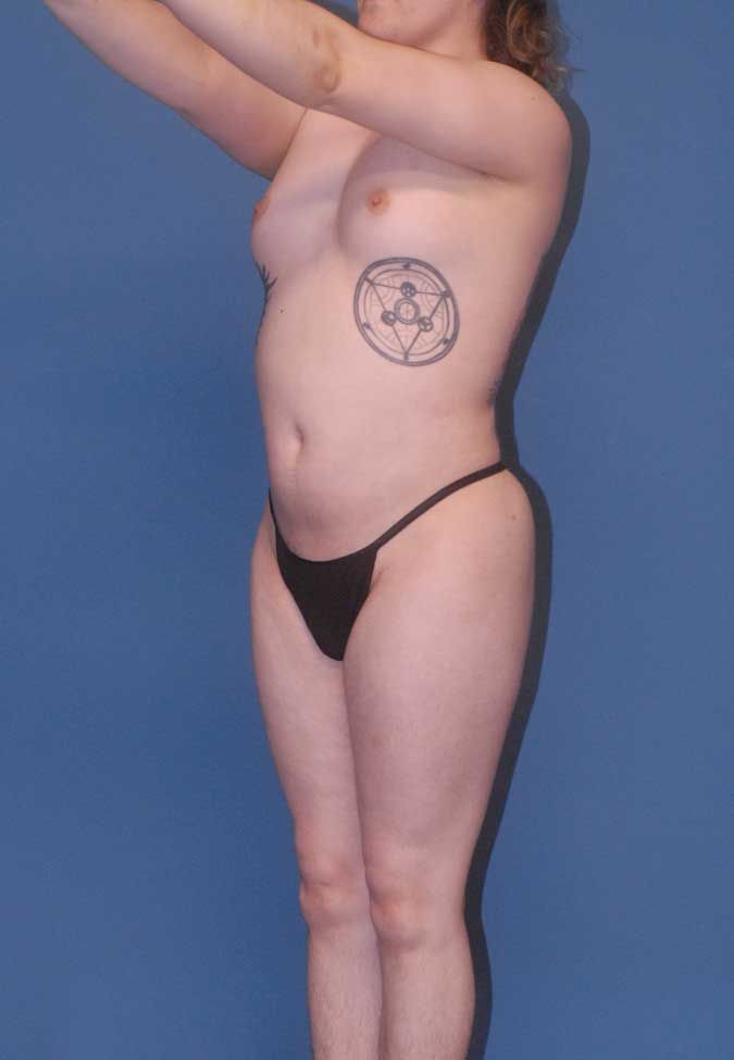 Male To Female Breast Contouring Before & After