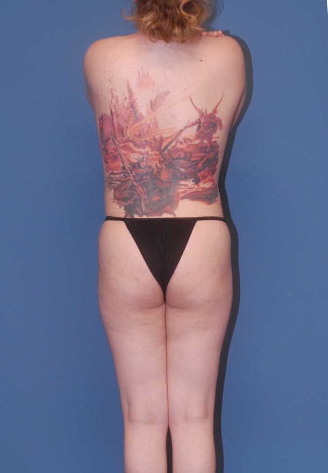 Male To Female Breast Contouring Before & After