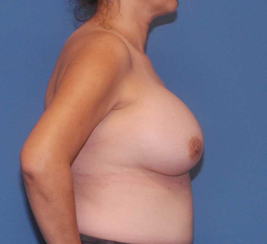 Breast Augmentation Before & After