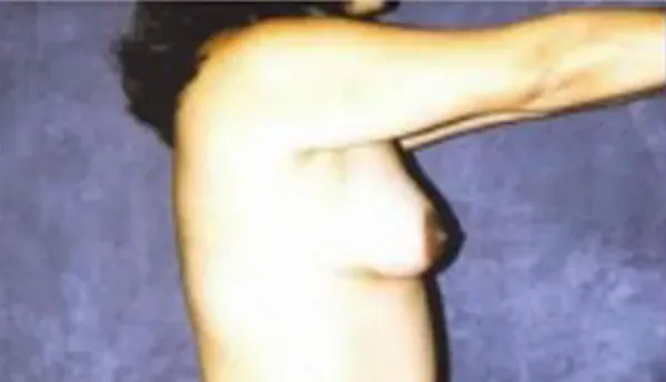 Breast Augmentation Before & After