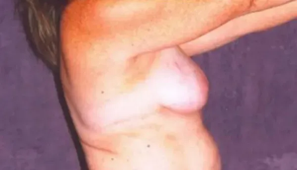 Breast Augmentation Before & After