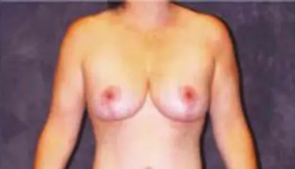 Breast Augmentation Before & After