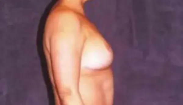 Breast Augmentation Before & After