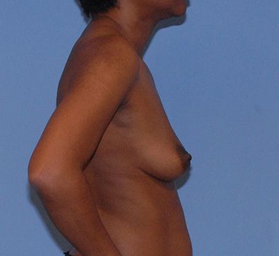 Breast Augmentation Before & After