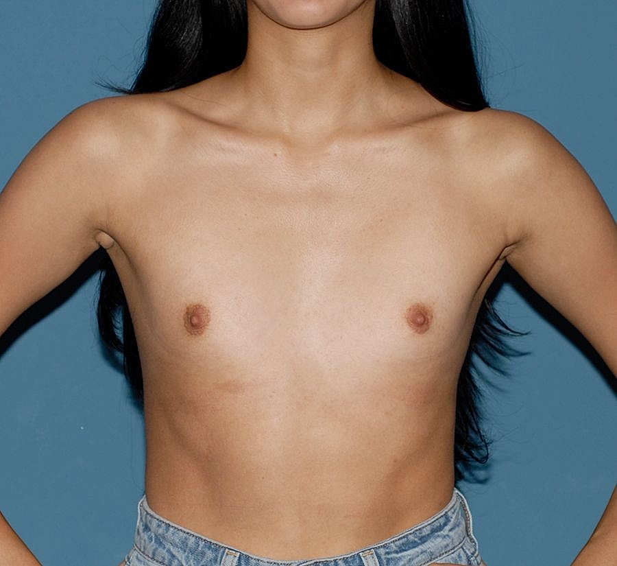 Breast Augmentation Before & After