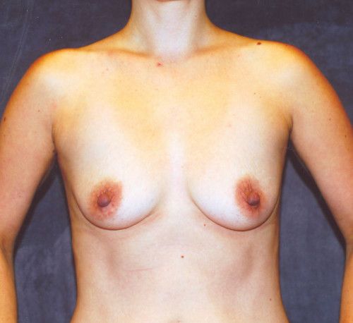 Breast Augmentation Before & After