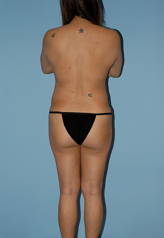 Breast Augmentation Before & After