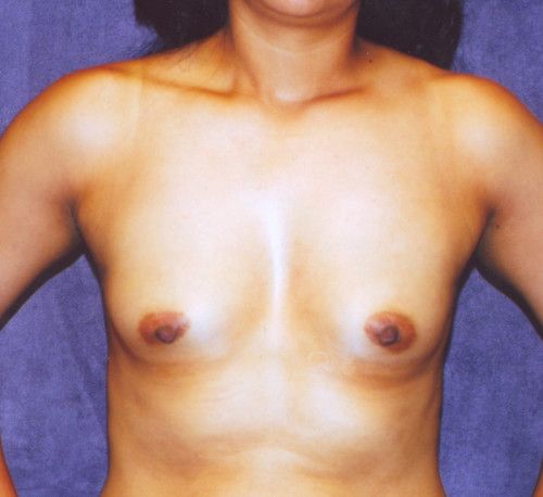 Breast Augmentation Before & After