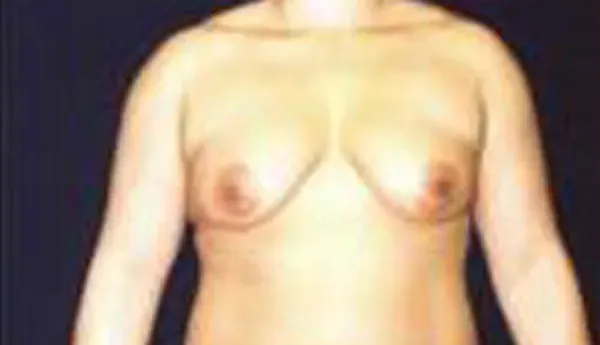 Breast Augmentation Before & After