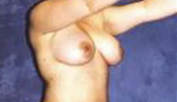 Breast Augmentation Before & After