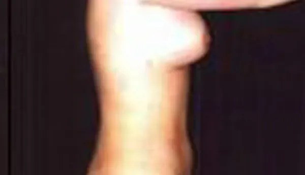 Breast Augmentation Before & After