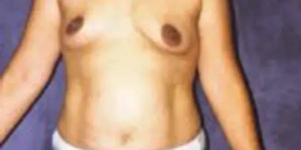 Breast Augmentation Before & After