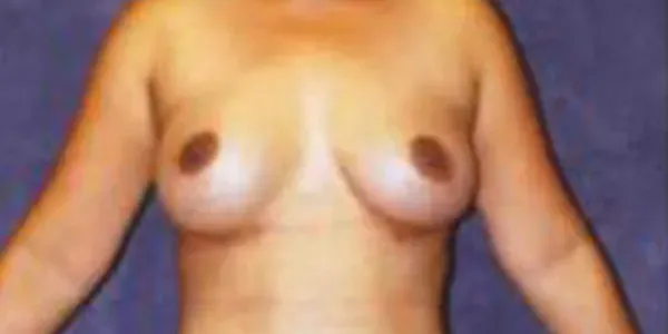 Breast Augmentation Before & After