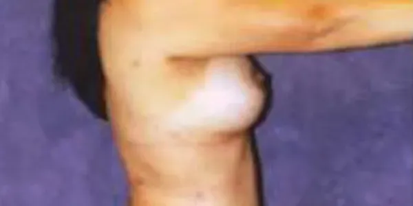 Breast Augmentation Before & After