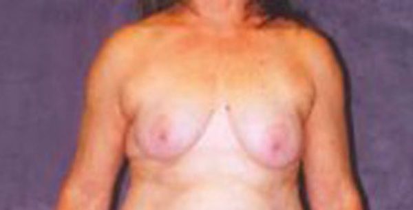 Breast Augmentation Before & After