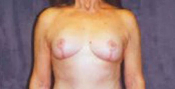 Breast Augmentation Before & After