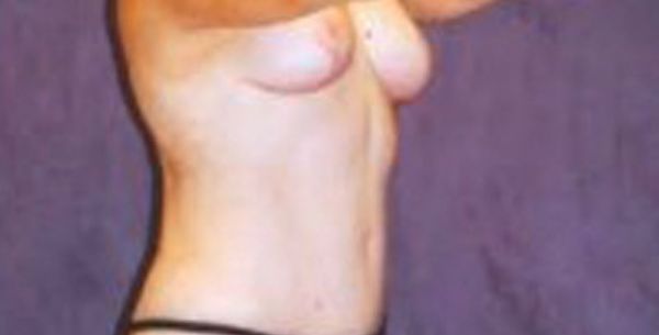 Breast Augmentation Before & After