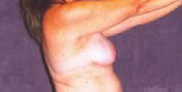 Breast Augmentation Before & After