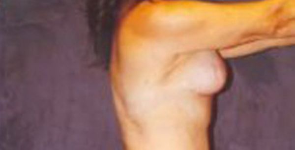 Breast Augmentation Before & After