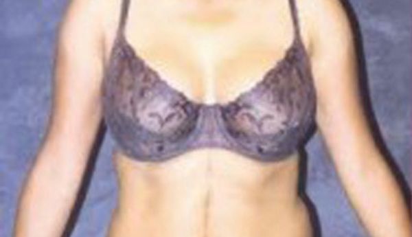 Breast Augmentation Before & After