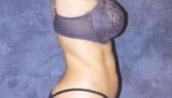 Breast Augmentation Before & After