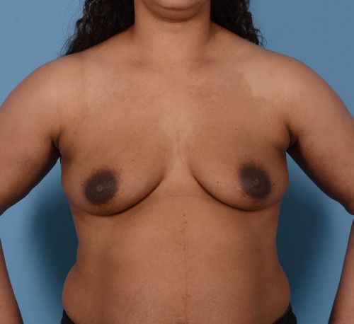 Breast Augmentation Before & After