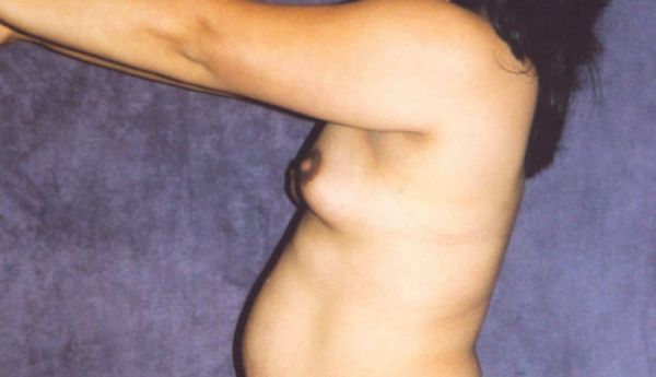 Breast Augmentation Before & After