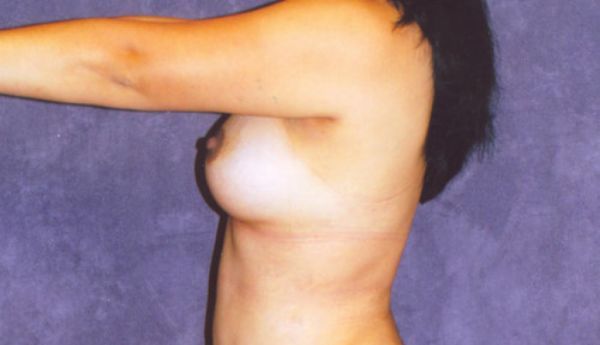 Breast Augmentation Before & After