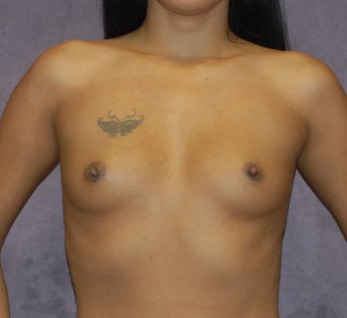 Breast Augmentation Before & After