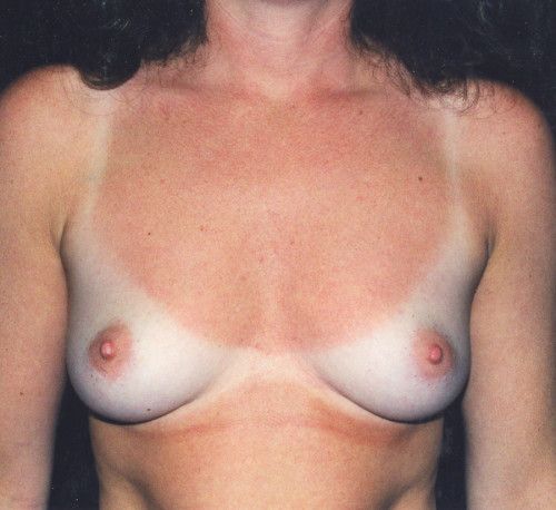 Breast Augmentation Before & After