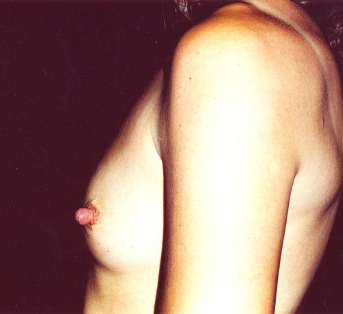 Breast Augmentation Before & After