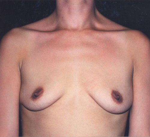 Breast Augmentation Before & After