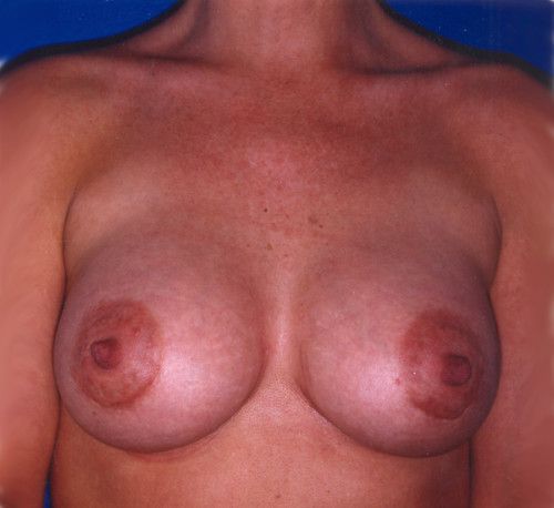 Breast Augmentation Before & After