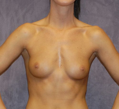 Breast Augmentation Before & After