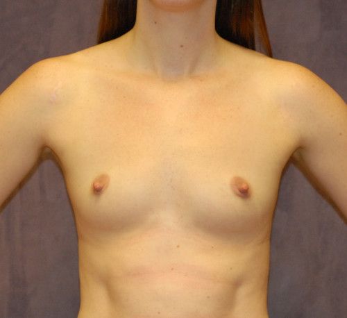 Breast Augmentation Before & After