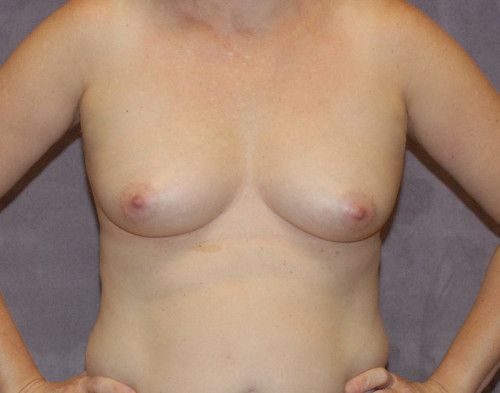 Breast Augmentation Before & After