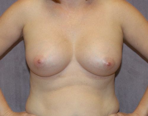 Breast Augmentation Before & After