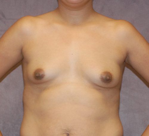 Breast Augmentation Before & After