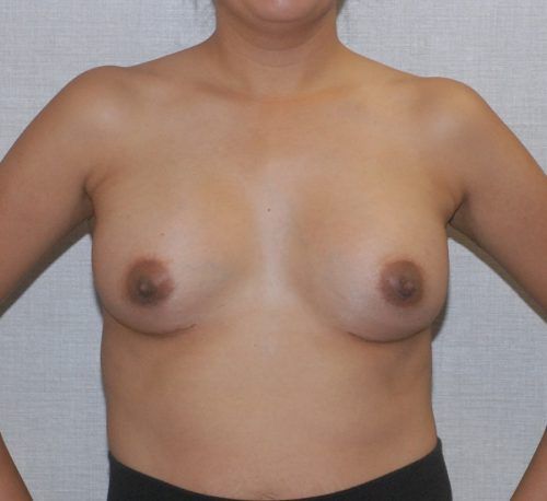 Breast Augmentation Before & After