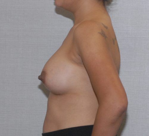 Breast Augmentation Before & After
