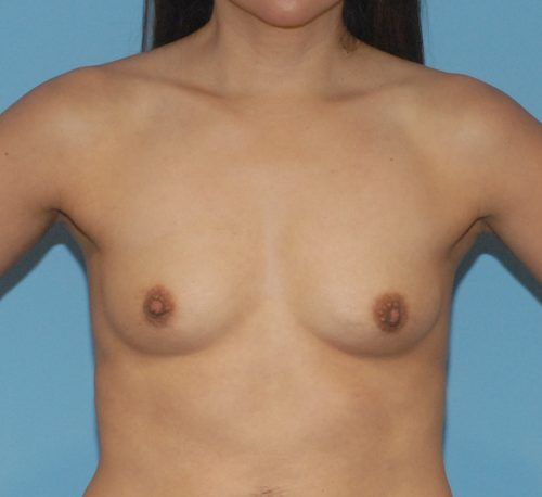 Breast Augmentation Before & After